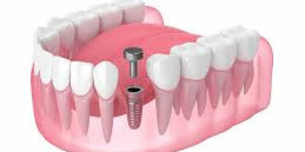 Strategic Dental Healing Caps Market Research Highlights Key Insights and Industry Trends