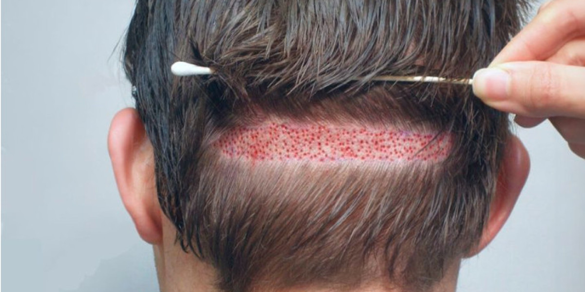 Why Choose Hair Transplant Pakistan by a Trusted Expert