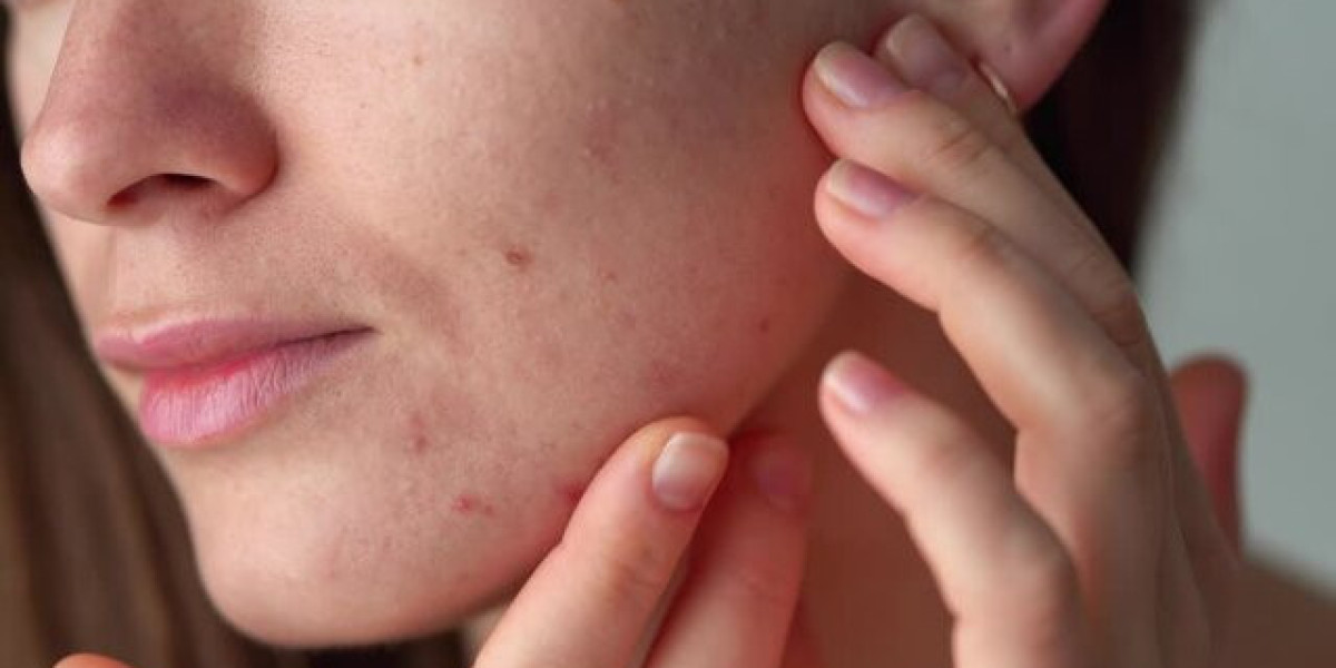 From Hormonal to Cystic: A Complete Breakdown of Every Type of Acne and the Right Treatment for Each