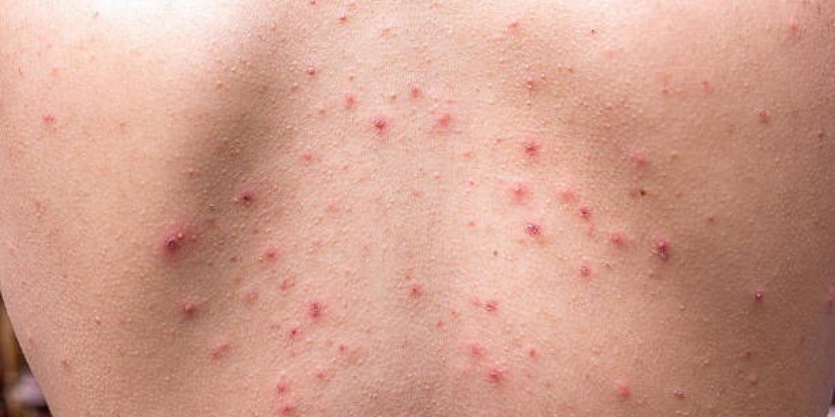 Transform Your Back: How to Treat Acne and Its Troubling Effects