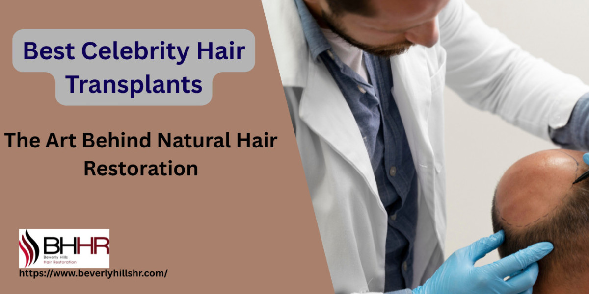 Best Celebrity Hair Transplants: The Art Behind Natural Hair Restoration