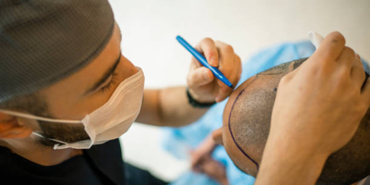 How Hair Transplant Technology Has Advanced in Riyadh