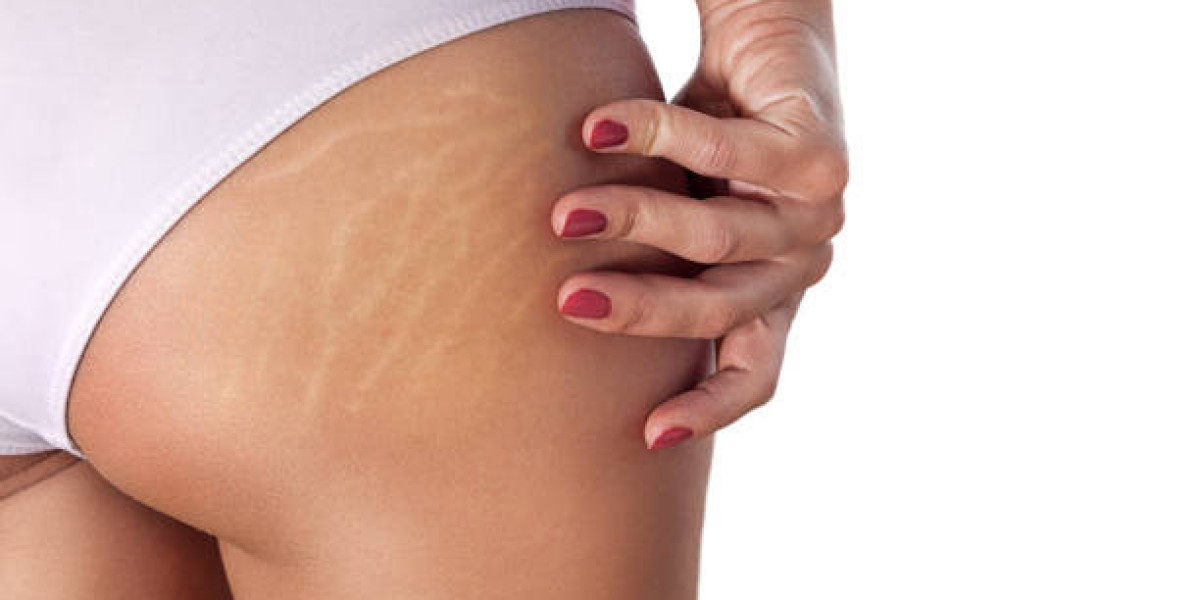 How effective is laser therapy for stretch mark fading?