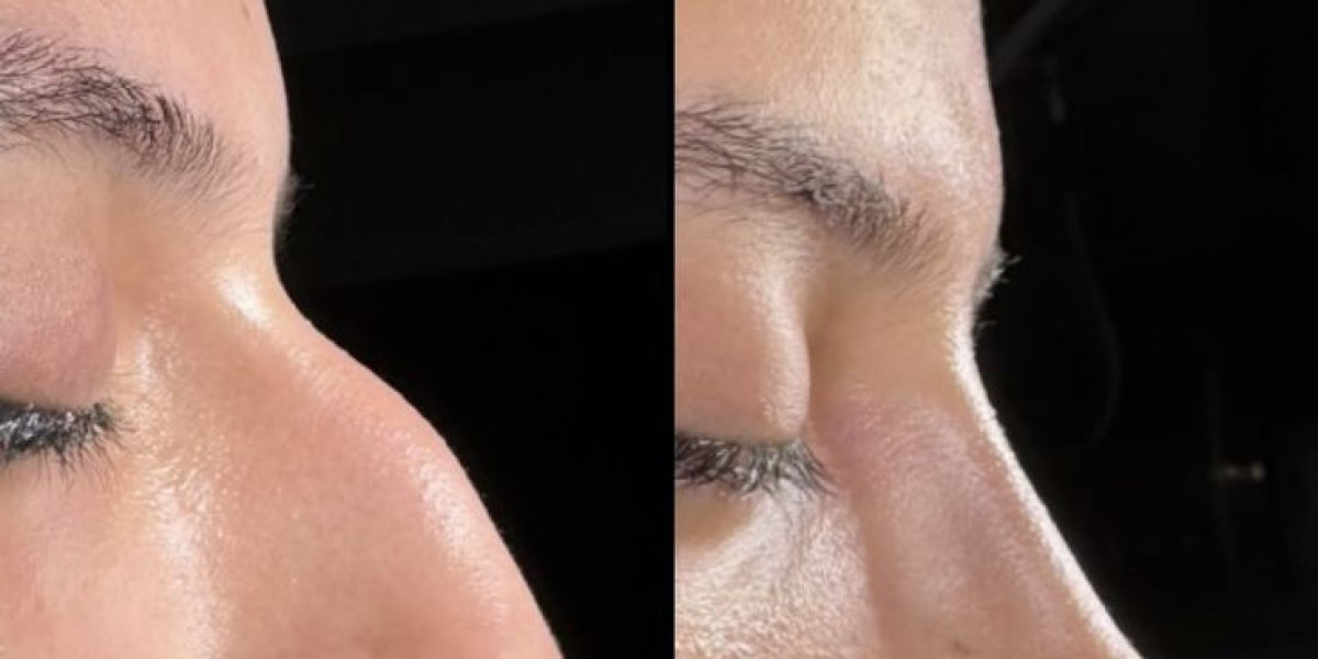 Rhinoplasty in Islamabad: A Complete Overview of Nose Reshaping Surgery