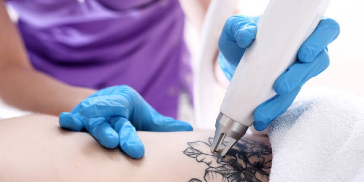 How many laser sessions for complete tattoo fading?
