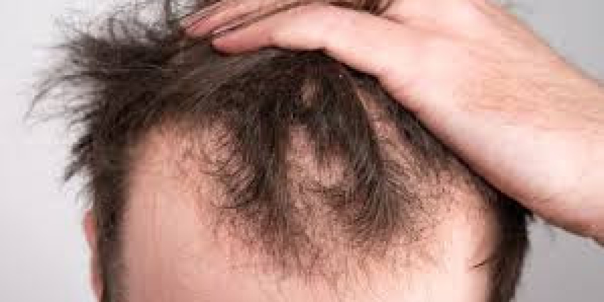Regrow Strong Strands via Holistic Hair Loss Treatment Plans