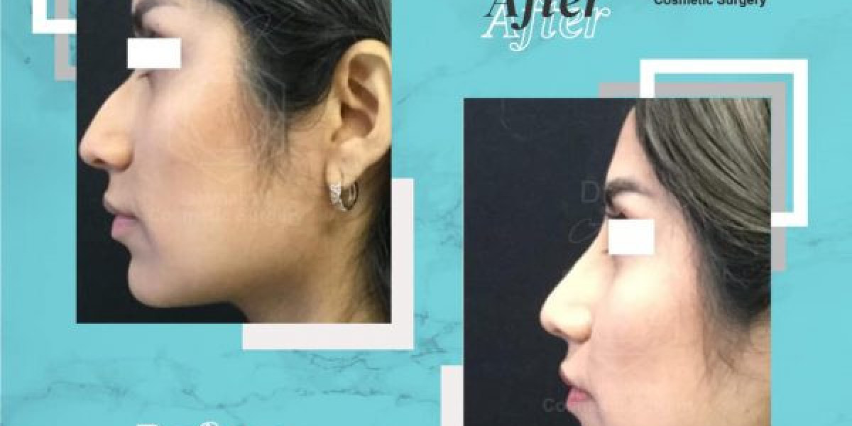 Rhinoplasty in Islamabad: Complete Guide for Beginners Step by Step