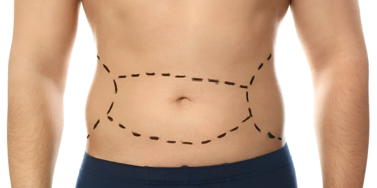 Get a Toned Look with Tummy Tuck Surgery in Islamabad